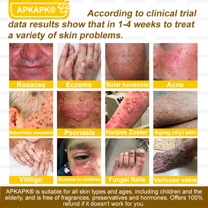 Instant Recovery🔥FDA Official: APKAPK® Bee Venom Skin Restoration Spray - Anti-aging, Hydrating, Skin Firming & Lifting, Skin Repair, Even Tone, Acne and Dark Spot Treatment, Wart and Mole Removal, and Psoriasis Relief.