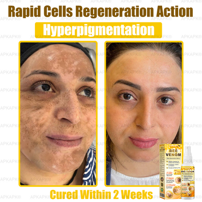 Instant Recovery🔥FDA Official: APKAPK® Bee Venom Skin Restoration Spray - Anti-aging, Hydrating, Skin Firming & Lifting, Skin Repair, Even Tone, Acne and Dark Spot Treatment, Wart and Mole Removal, and Psoriasis Relief.
