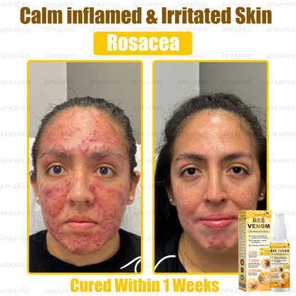 Instant Recovery🔥FDA Official: APKAPK® Bee Venom Skin Restoration Spray - Anti-aging, Hydrating, Skin Firming & Lifting, Skin Repair, Even Tone, Acne and Dark Spot Treatment, Wart and Mole Removal, and Psoriasis Relief.