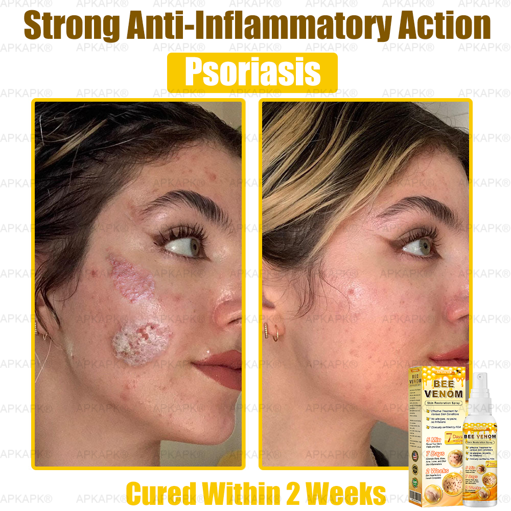 Instant Recovery🔥FDA Official: APKAPK® Bee Venom Skin Restoration Spray - Anti-aging, Hydrating, Skin Firming & Lifting, Skin Repair, Even Tone, Acne and Dark Spot Treatment, Wart and Mole Removal, and Psoriasis Relief.