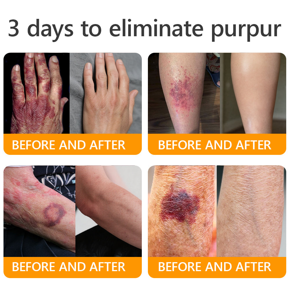 ⚡𝐌𝐇𝐑𝐀 𝐌𝐚𝐝𝐞 𝐚𝐧𝐝 𝐬𝐡𝐢𝐩𝐩𝐞𝐝 𝐟𝐫𝐨𝐦 𝐔𝐒𝐀✨𝗔𝗣𝗞𝗔𝗣𝗞® 𝗕𝗲𝗲 venom SkinRestoration Cream, Fine Lines, loss ofFirmness, Flat Bust, DroopingHips, and More